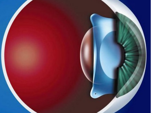 谁做过ICL人工晶体植入手术?-德视佳官网(euroeyes)