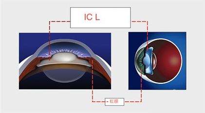 icl晶体手术