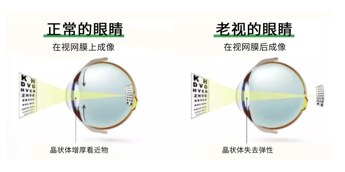 散光加老花眼能手术矫正吗德视佳三焦点晶体手术怎么样