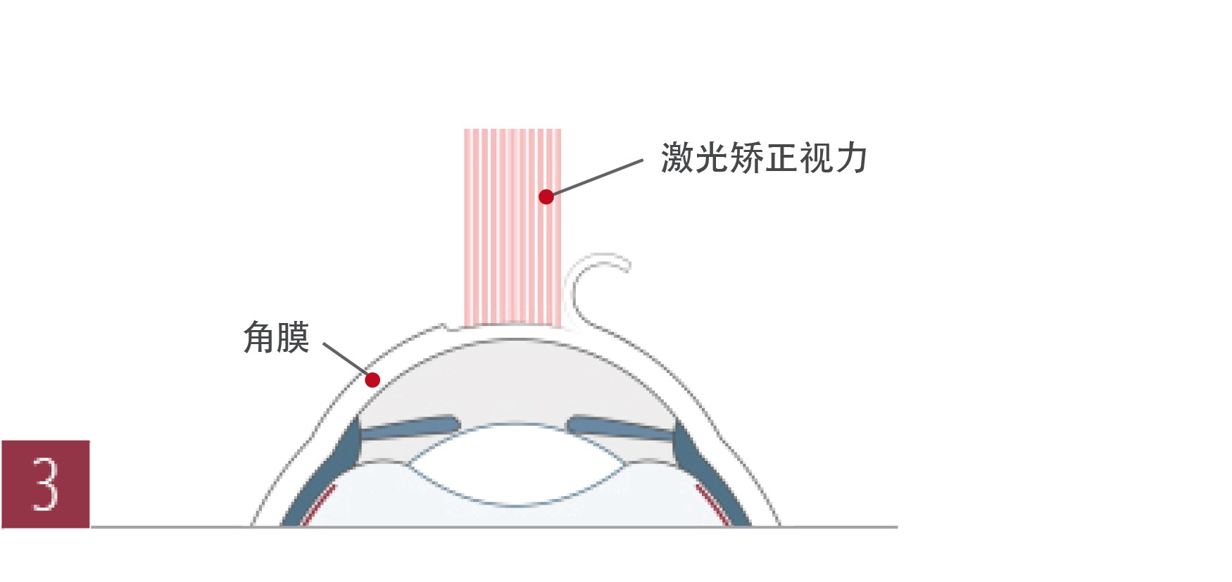 准分子激光