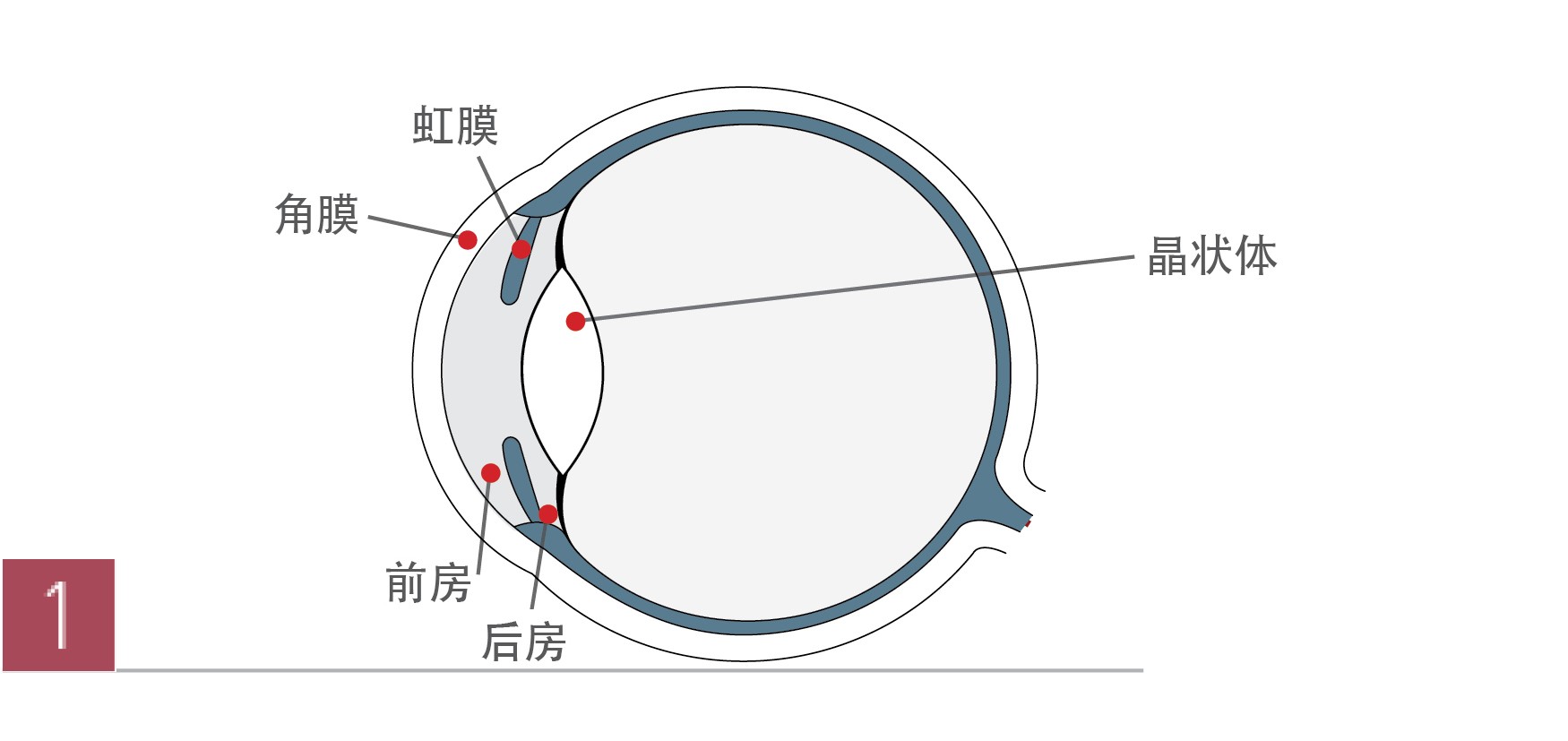 ICL晶体植入术