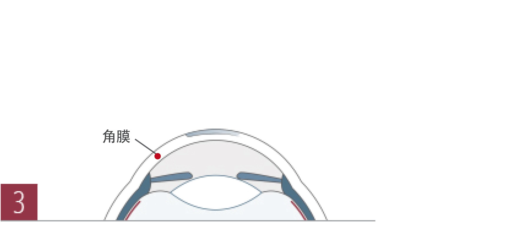 秒激光lasik