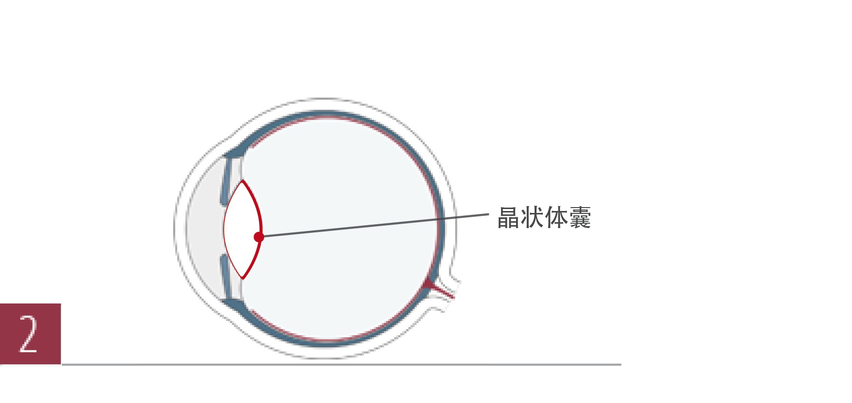 三焦晶体置换术