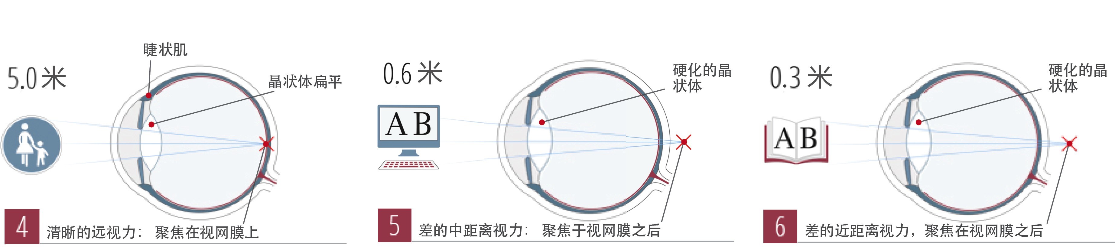 老花眼的早期症状