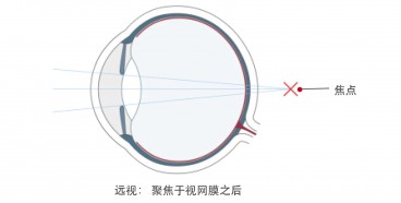 远视眼手术