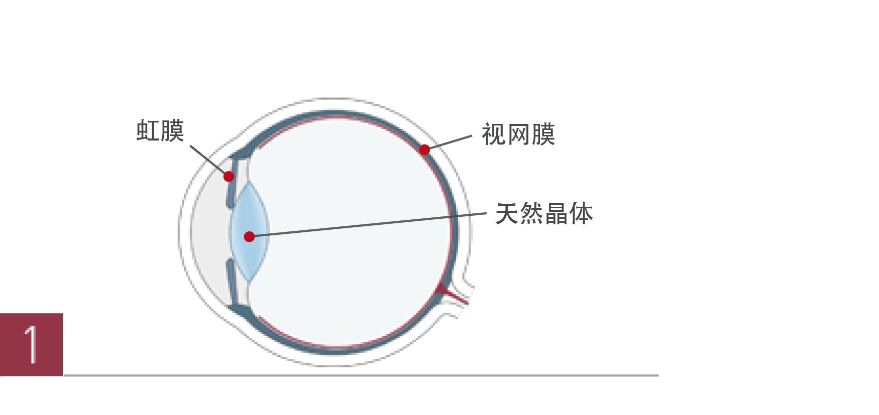 白内障手术治疗