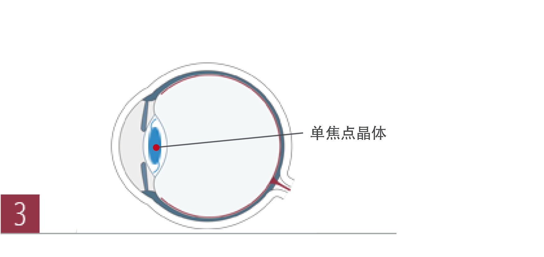 白内障手术治疗