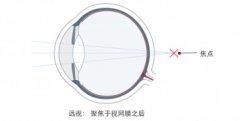 远视是什么