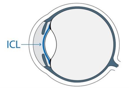 ICL晶体植入，矫正高度近视技术新跨越