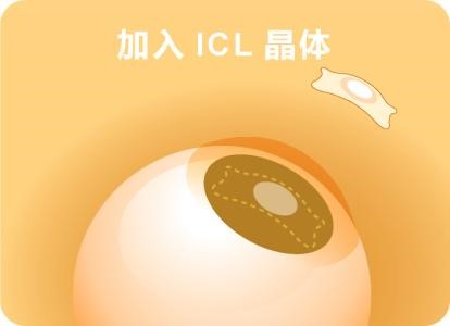 ICL手术注意事项