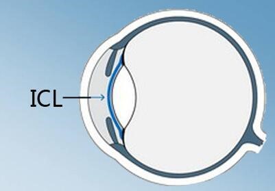 ICL晶体植入有哪些优势？