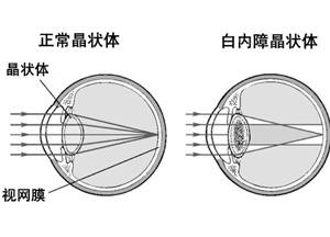 莎普爱思的骗局，白内障的真正手术方法