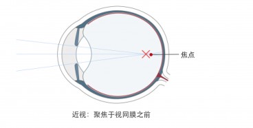 近视老花眼区别