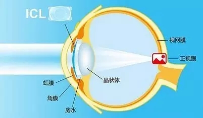 icl近视植入晶体危害