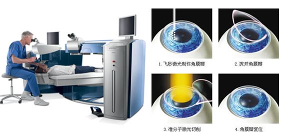德国飞秒激光费用多少