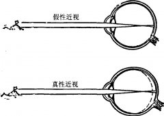 怎样矫正近视眼