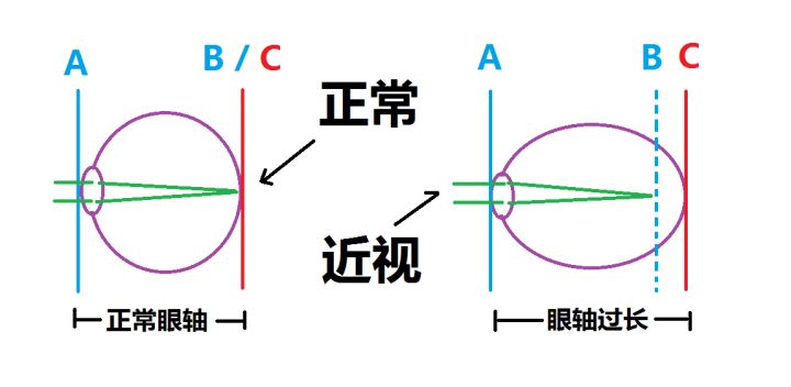 怎样手术近视