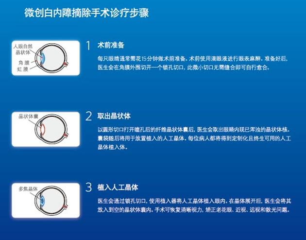 无刀飞秒激光白内障手术