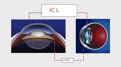 植入晶体手术