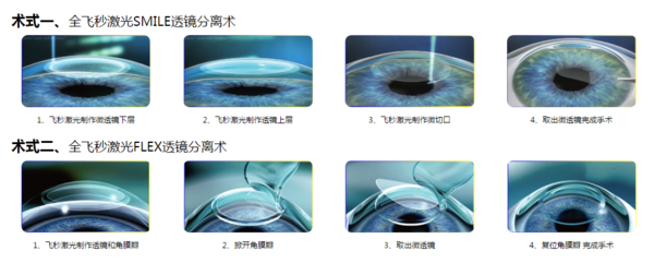 全飞秒 smile flex 区别