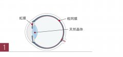 老花眼的手术