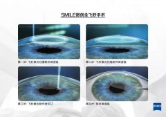 Smart全激光和全飞秒Smile3.0有什么区别？全飞秒