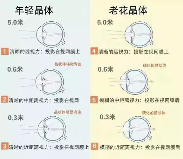 老花白内障也许会迟到但不会缺席