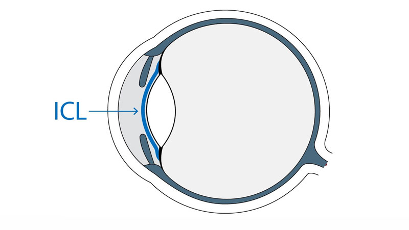 高度近视做ICL晶体植入视
