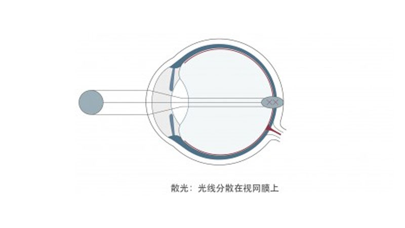 散光能做近视眼手术吗？广州近视手术能矫正散光吗？