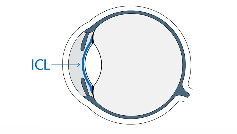 敲黑板！ICL晶体植入手术大揭秘