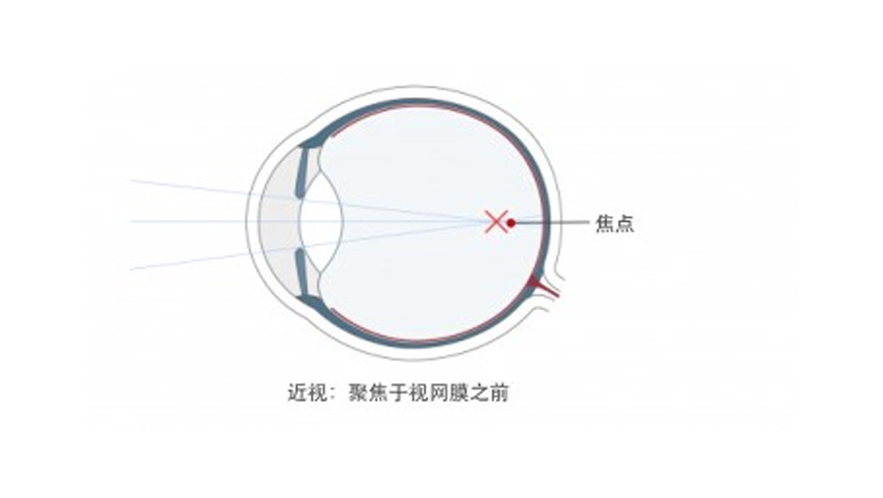 德视佳科普：近视矫正手术的原理和适应症