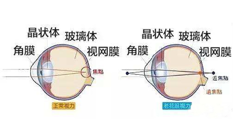 老龄化社会到来，老花眼手术和眼健康成热点