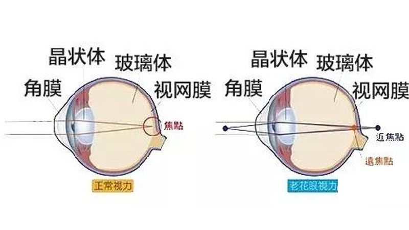 老花眼手术，为什么要选蔡司三焦点人工晶体？