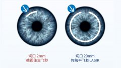 屈光不正的矫正方法有哪些？深圳全飞秒激光手术哪家医院好？