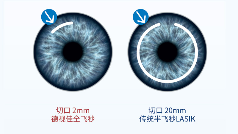 激光矫正近视手术全飞秒和半飞秒区别