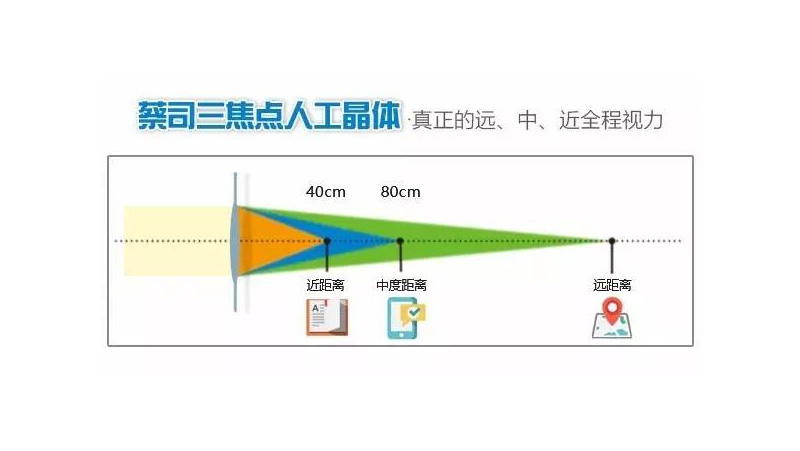 老花眼矫正三焦晶体置换手术贵吗?