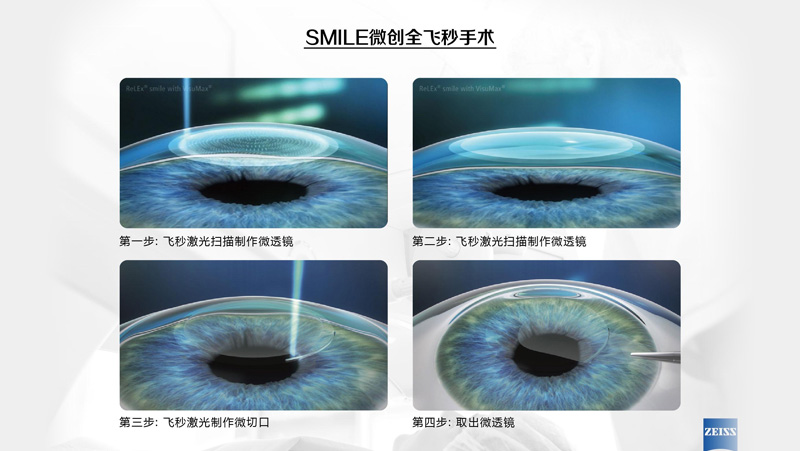 矫正近视，杭州全飞秒近视激光手术哪家医院好？