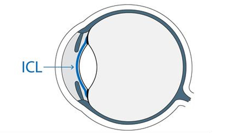 ICL植入手术效果真的好吗？