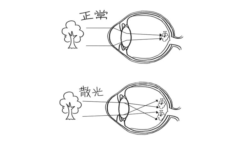 一旦出现就不可逆？关于散光，看这一篇就够了