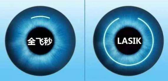 矫正近视有方法