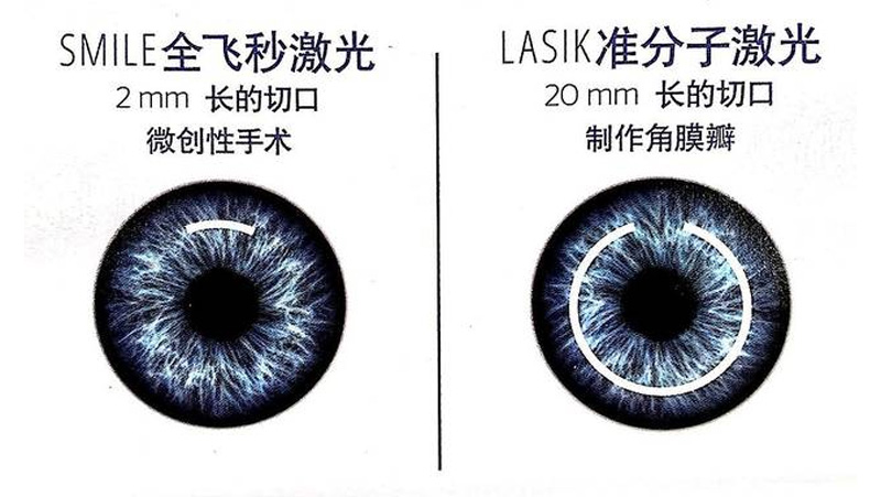 想知道自己适不适合全飞秒？德视佳给你答案