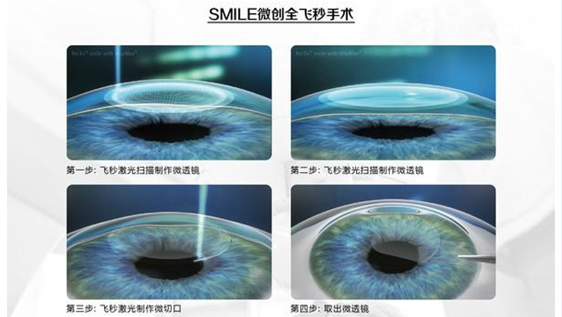 北京视力矫正手术哪家医