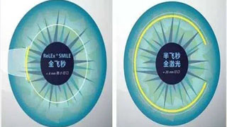 上海矫正近视医院哪个比较好 全飞秒激光近视手术好不好