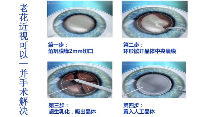 老花近视可以一并手术解决吗？老花眼三焦晶体置换术！