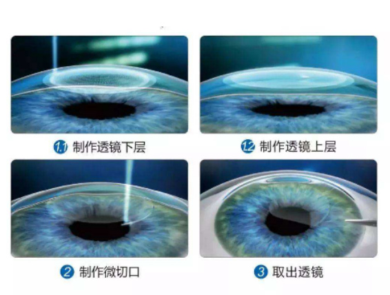 全飞秒激光近视手术矫正近视，全飞秒矫正近视有什么风险？