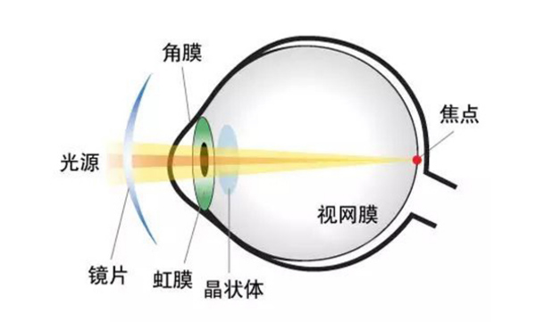 近视1000度能做手术吗？全