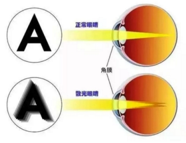 近视多少度可以手术？近视手术有什么要求？
