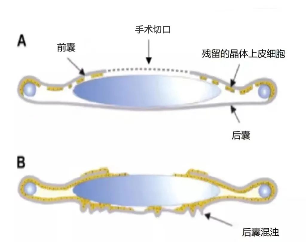 老花眼手术后又看不清了，怎么回事？