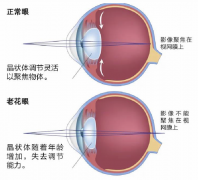 猝不及防就老花？38岁+如何突破困“镜”