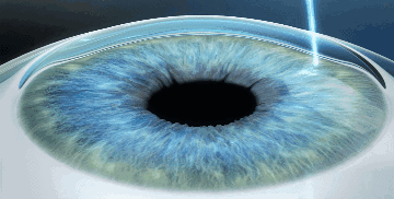 Femto Lasik 半飞秒激光手术